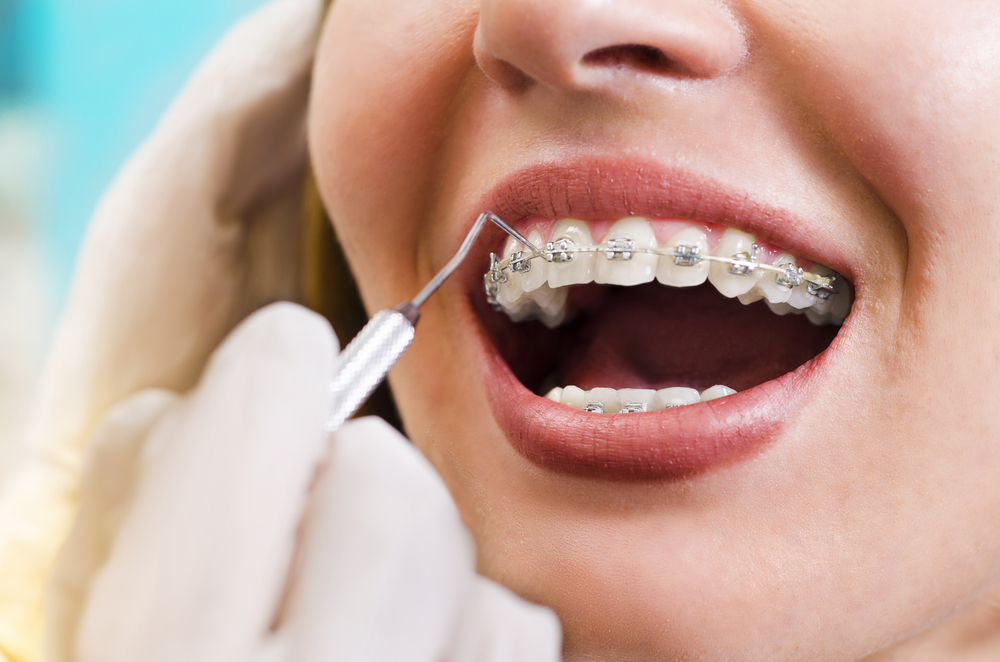  Braces Treatment